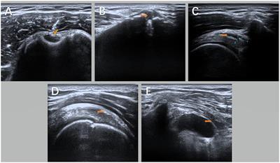 Comparative study of ultrasonic-guided betamethasone local injection and extracorporeal shock wave therapy in post-stroke hemiplegic shoulder pain: a randomized clinical trial